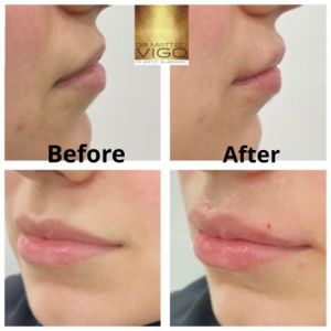 Face Fillers Lip filler