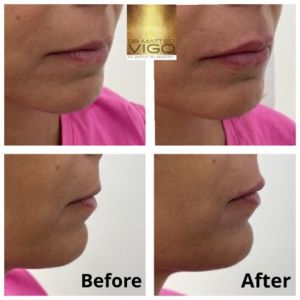 Face Fillers Lip filler