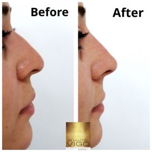 Face Fillers non surgical rhinoplasty with filler