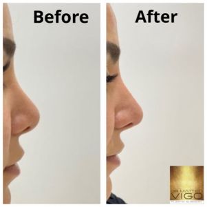 Face Fillers correction of previous rhinoplasty with filler