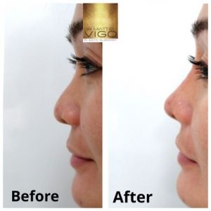 Face Fillers non surgical rhinoplasty with filler