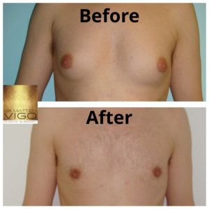 Gynecomastia – correction with liposuction and gland removal