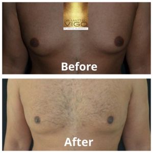 Gynecomastia – correction with liposuction and gland removal