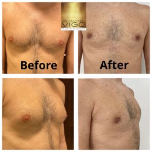 Gynecomastia – correction with liposuction and gland removal