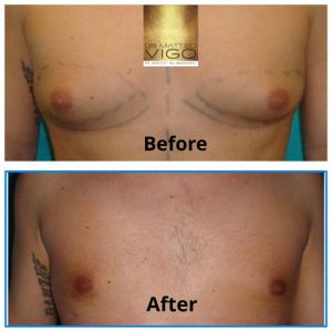 Gynecomastia – correction only with liposuction