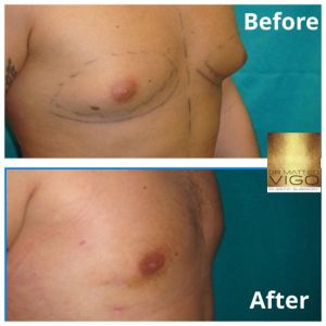 Gynecomastia – correction only with liposuction