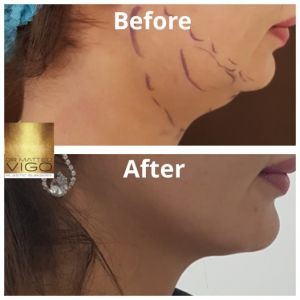 Jawline Definition with J-Plasma 