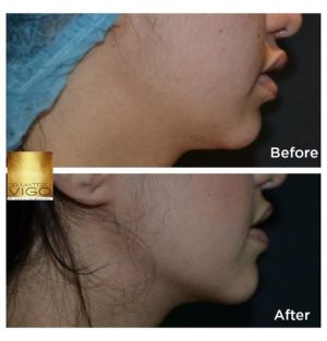 Jawline Definition with J-Plasma 