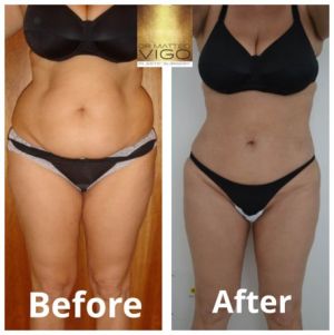 Liposuction abdomen flanks and inner thighs