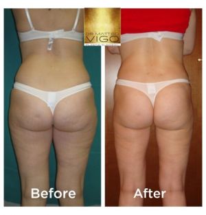 Liposuction abdomen, flanks, inner and outer thighs and knees