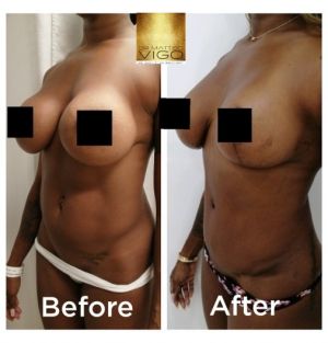 Mommy Makeover breast implant substitution with lifting and abdominoplasty