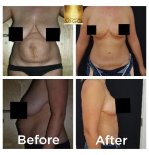 Mommy Makeover breast reduc tion and abdominoplasty with muscle resuture