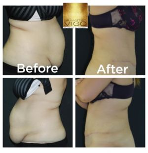 Tummy Tuck