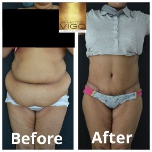 Tummy Tuck