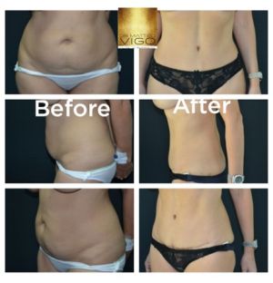 Tummy Tuck