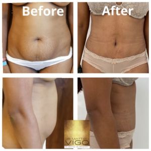 Tummy Tuck