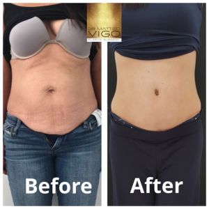 Tummy Tuck