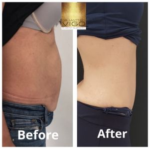 Tummy Tuck