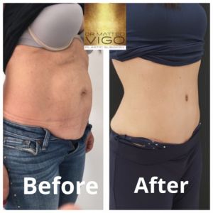 Tummy Tuck