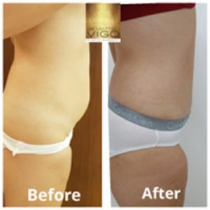 Tummy Tuck