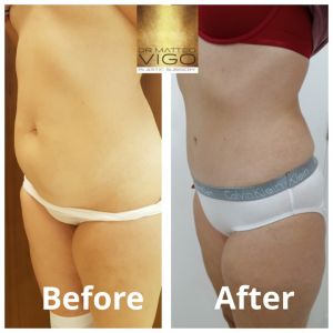 Tummy Tuck