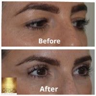 Upper Blepharoplasty 6 Months After