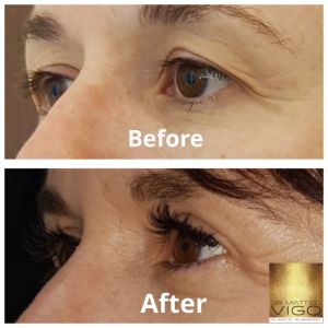 Upper Blepharoplasty 6 Months After