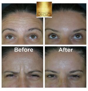 Botox forehead, glabella and crow’s feet