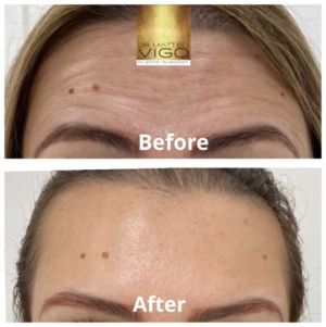 Botox forehead, glabella and crow’s feet