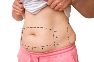 Abdominoplasty Dubai