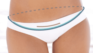 Tummy Tuck Dubai