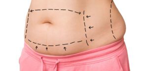 abdominoplasty dubai