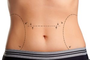 tummy tuck dubai