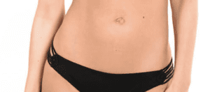 Tummy Tuck Dubai 