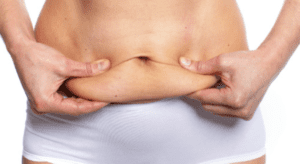 Tummy Tuck Dubai
