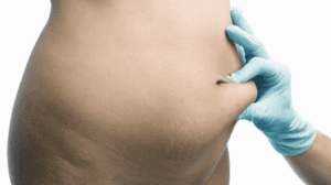 Tummy Tuck Dubai