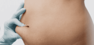 Tummy Tuck Dubai