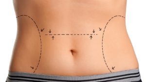 Tummy Tuck Dubai