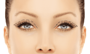 Blepharoplasty Dubai