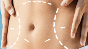 Tummy Tuck Dubai