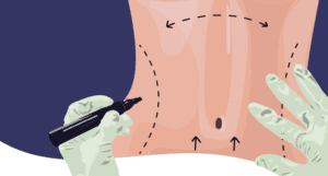 Tummy Tuck Dubai