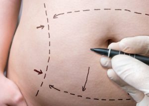 tummy tuck dubai