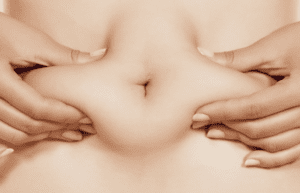 Tummy Tuck Dubai