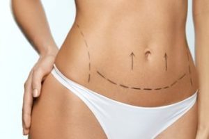 Tummy Tuck Dubai