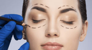 Blepharoplasty Dubai