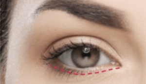 Blepharoplasty Dubai