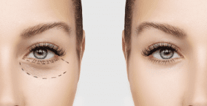 Blepharoplasty Dubai