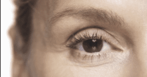 Blepharoplasty Dubai