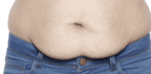 Tummy Tuck Dubai