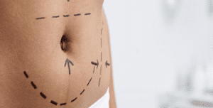 Abdominoplasty Dubai